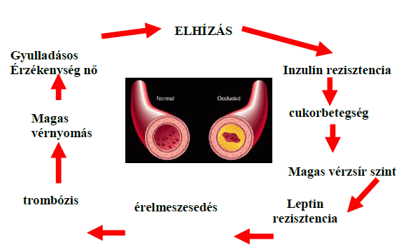 Diabess Tea | Metabolikus szindróma – nem fáj, de halálosan veszélyes!