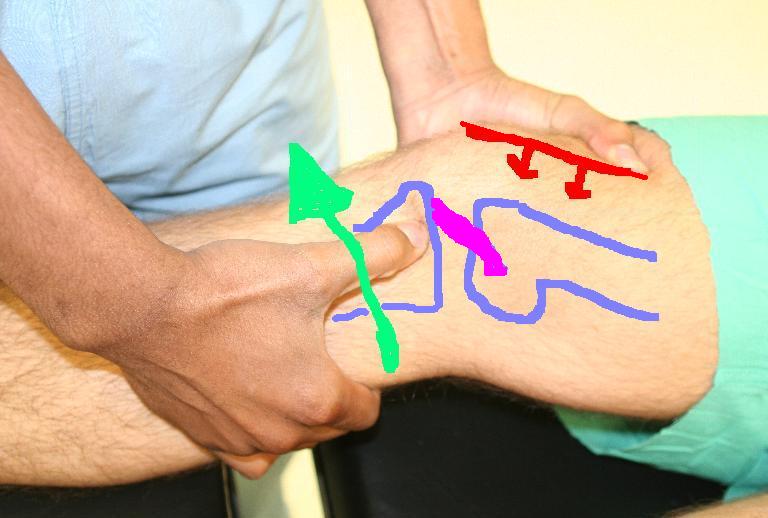 a térd osteoarthritisének felülvizsgálata 2 fokon