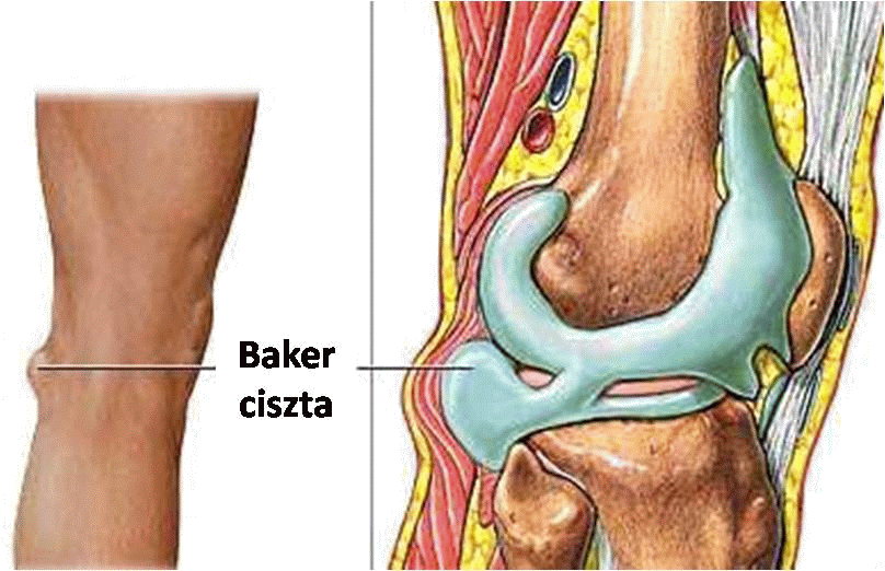 patella alatti fájdalom