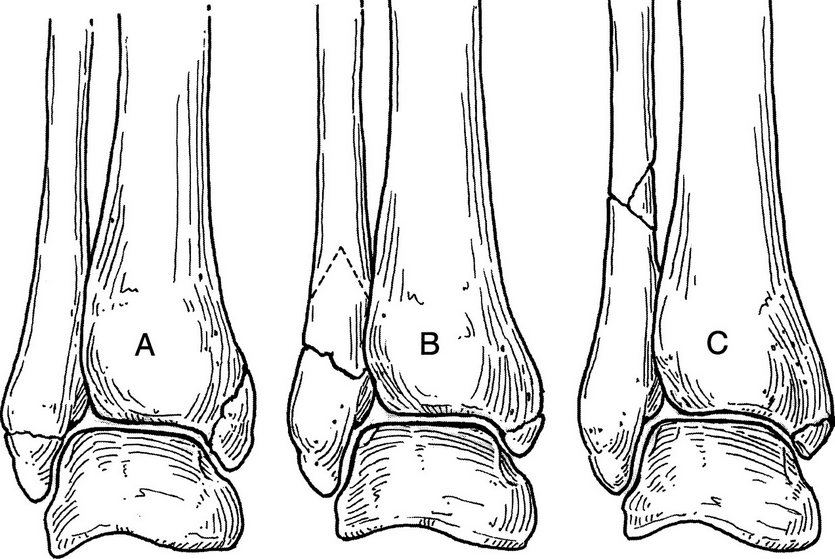 tibia törés gyógyulása