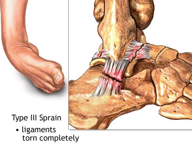 boka sérülés ligamentum törése