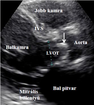 fogyás és aorta stenosis