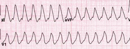 hipertrófia magas vérnyomás tachycardia