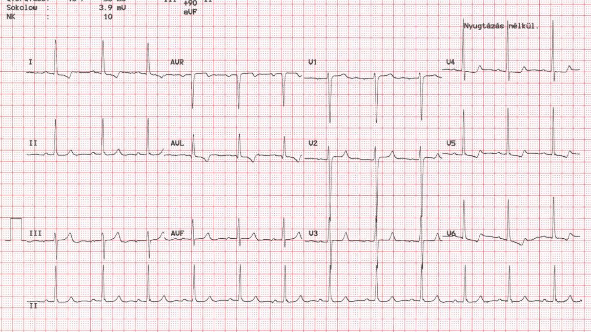 Mi a szív kamrai bal kamrai hipertrófia, jellemző jelek és kezelés - Magas vérnyomás November