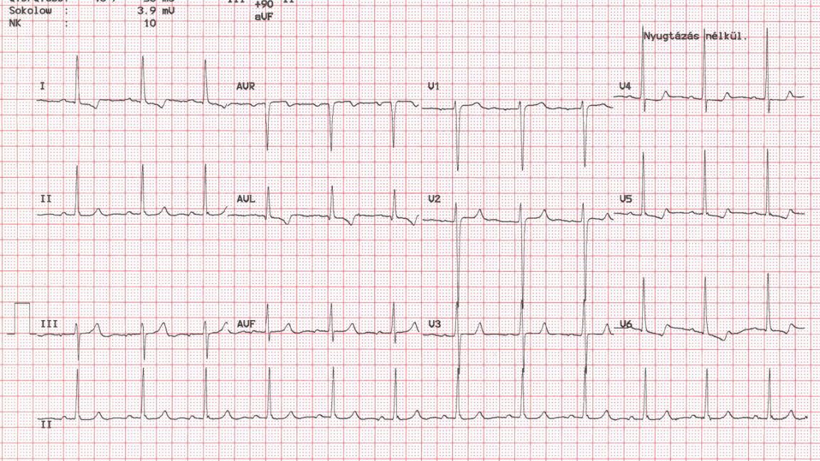 sinus tachycardia és magas vérnyomás hipertónia teljes gyógyítása