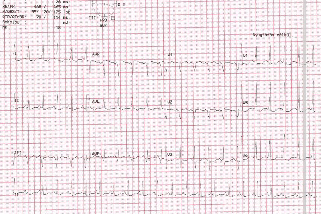 magas vérnyomás 2 fokos ekg