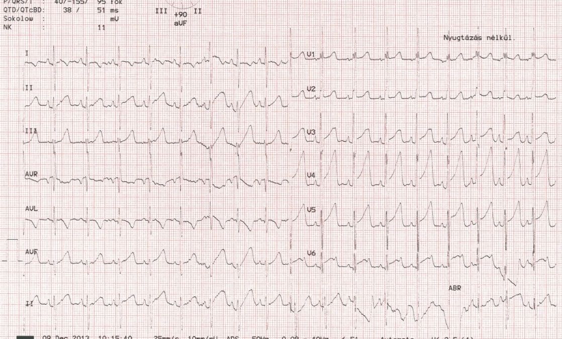 bradycardia tachycardia hipertónia hipotenzió