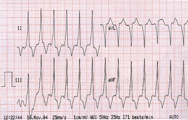 hipertrófia magas vérnyomás tachycardia)