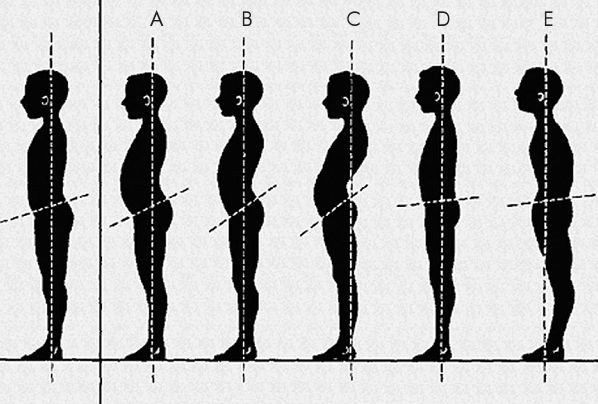 lumbalis lordosis jelentése