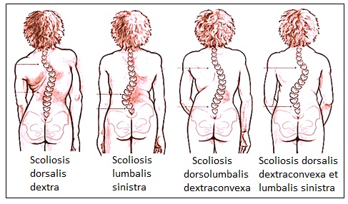 A gerinc ortopédiai betegségei