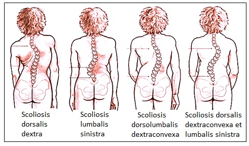 fokozott lumbalis lordosis jelentése