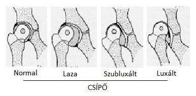 csípő szubluxációs kezelés áttekintése