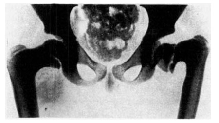 a csípőízület röntgenbetegségei bal váll fájdalom kezelése