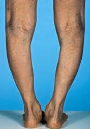 az alsó lábszár és a bokaízület károsodása