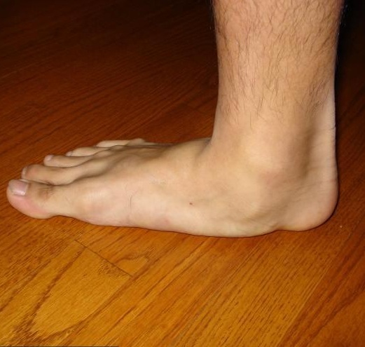 lapos lábú és a térdízület kezelése